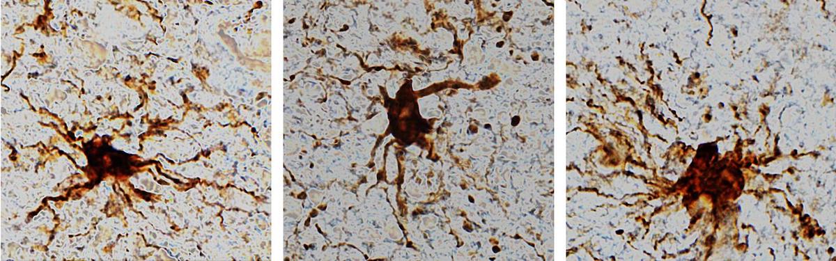 cellules zombies reviennent vie mort cerveau