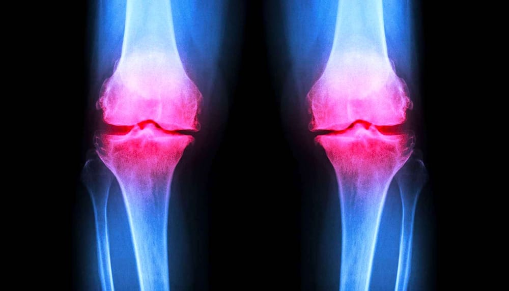 Un hydrogel injectable pour régénérer le cartilage endommagé des articulations