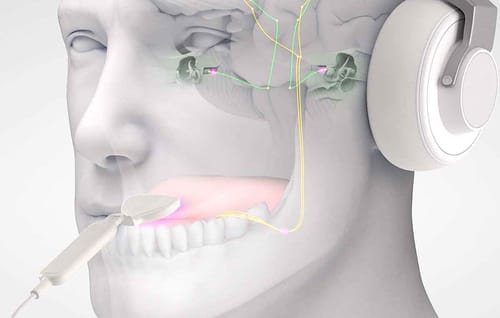 Acouphènes : un traitement à base de musique électronique et de stimulations de la langue