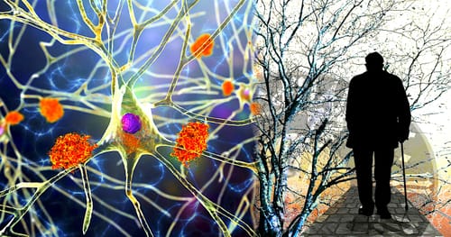 Alzheimer : des chercheurs identifient la cause de la progression agressive de la maladie