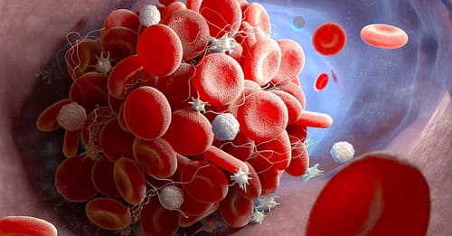 Le COVID long serait en partie dû à une surcharge de molécules inflammatoires piégées dans des micro-caillots sanguins