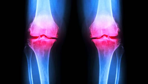 Un hydrogel injectable pour régénérer le cartilage endommagé des articulations