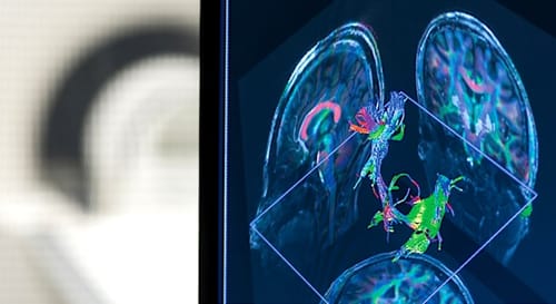 L'IRM 7 Tesla offre de nouvelles perspectives sur la sclérose en plaques