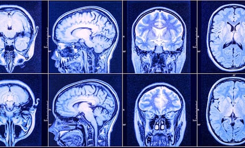 Un nouveau traitement prometteur contre le glioblastome, le cancer du cerveau le plus fréquent et agressif